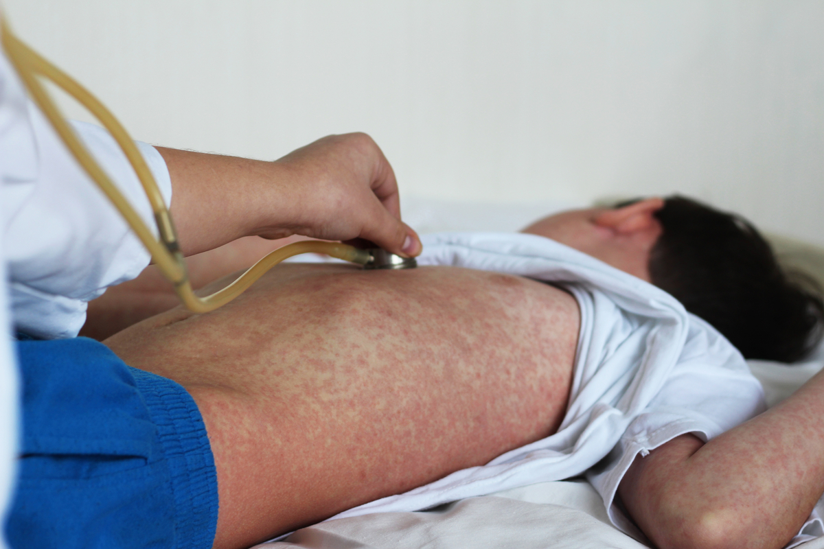 Measles Epidemic in Kazakhstan